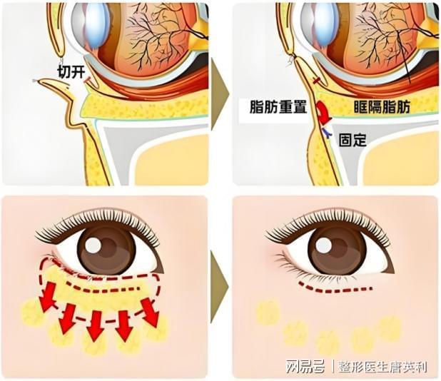 ：什么是眶隔释放——科普篇OG真人平台整形医生唐英利(图2)